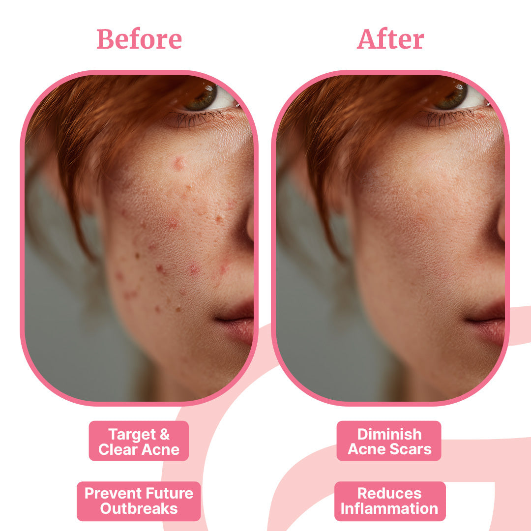 GlowUp™ Acne Wand
